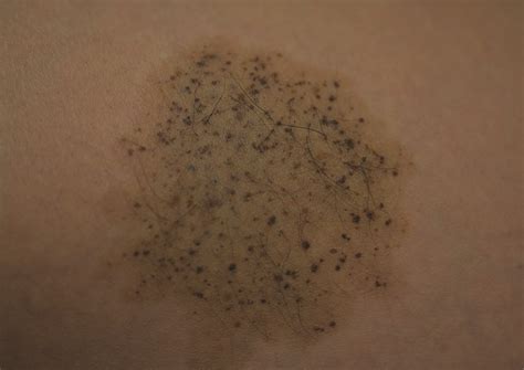 Nevus Spilus: Is the Presence of Hair Associated With an Increased Risk for Melanoma? | MDedge ...