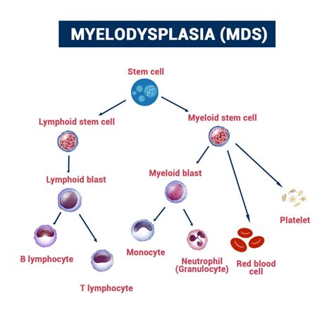 Myelodysplasia Treatment In Punjab, Myelodysplasia (MDS) Treatment Cost In Ludhiana