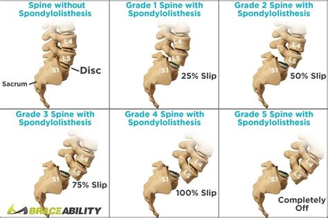 Spondylosis Types