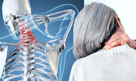 Arthritis: What are the symptoms you need to look for to identify neck problems? | Express.co.uk