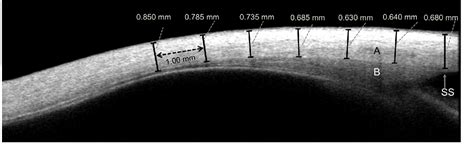 Structure of scleral spur | Semantic Scholar