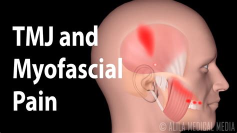 TMJ and Myofascial Pain Syndrome, Animation. | Doovi