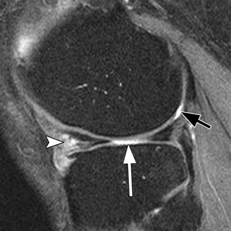 State of the Art: Imaging of Osteoarthritis—Revisited 2020 | Radiology