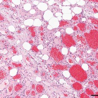 Chest radiograph appearances of an angiolipoma in a 71 year old female.... | Download Scientific ...