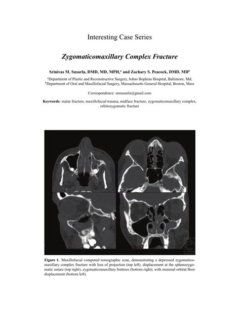 (PDF) Zygomaticomaxillary Complex Fracture