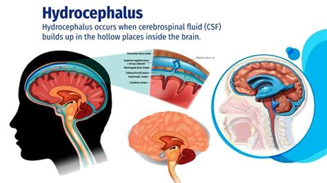 Hydrocephalus | Symptoms | Causes | Medicines | Homeopathic Treatment