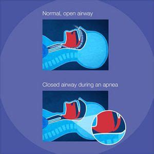 Why does my apnea–hypopnea index (AHI) change? - ResMed