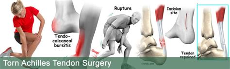 Torn Achilles Tendon In India: Things To Consider Going For The Surgery