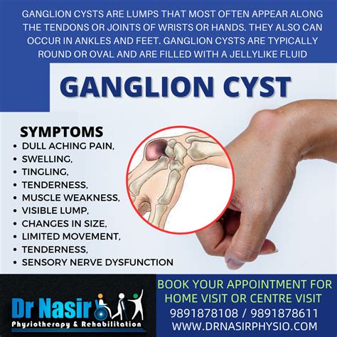 Ganglion cyst wrist treatment - Dr NasirPhysiotherapy and Rehabilation