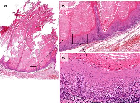 Keratoacanthoma Histology