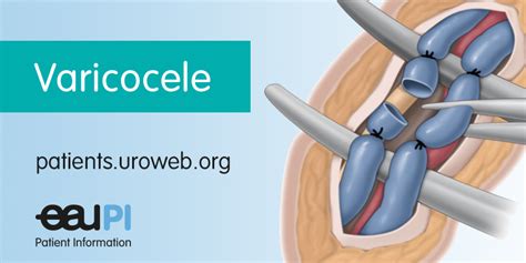 Varicocele - Patient Information