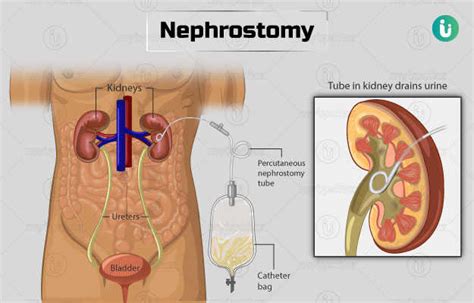 Nephrostomy: Procedure, Purpose, Results, Cost, Price