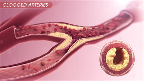 Clogged Arteries - Scientific Animations