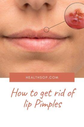 How To get rid of lip Pimples?