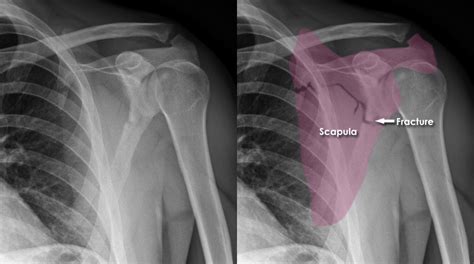 Trauma X-ray - Upper limb gallery 1 - Scapula fractures