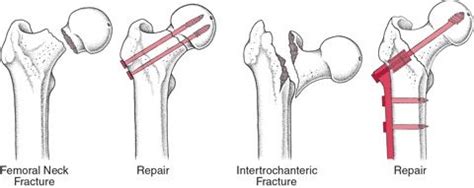 Hip Fracture Treatment Las Vegas | Patient Guide To Hip Fractures