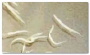 Worms in human feces - Pictures, Types, Symptoms, Treatment