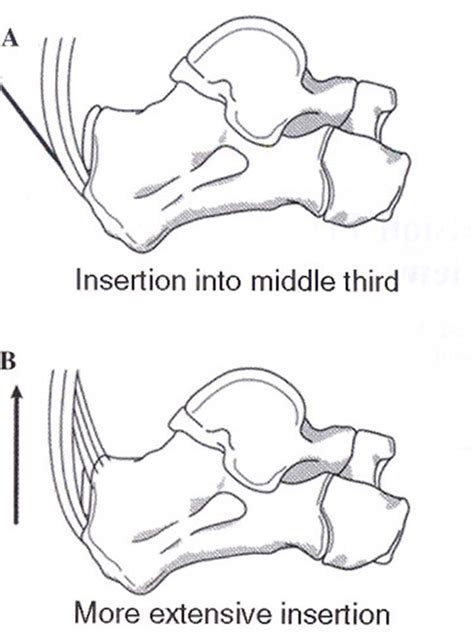 Avulsion Fracture of the Calcaneal Tuberosity: A soft tissue ...