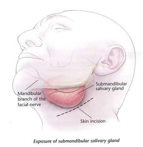 Excision submandibular gland (removing the large saliva gland from under the jaw) - Dr Bridget ...