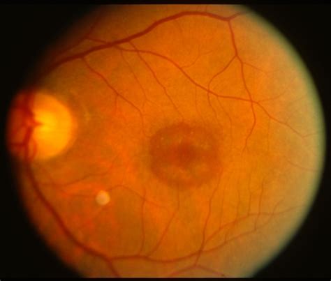 Bull's Eye Maculopathy - Retina Image Bank