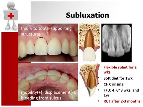 Traumatic Dental Injury and Treatment