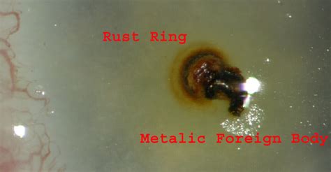 Corneal Rust Ring