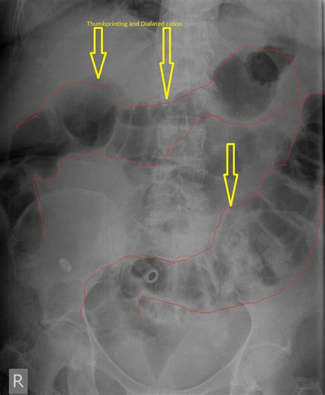 Ischemic colitis abdominal x ray - wikidoc