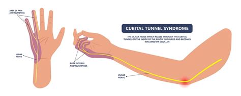 Cubital Tunnel Syndrome; Cause, Symptoms & Treatment - A2Z Healthy