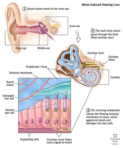 Noise-induced Hearing Loss (NIHL): Symptoms & Treatment - Tendig