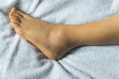 Swollen feet: 15 causes, treatments, and home remedies