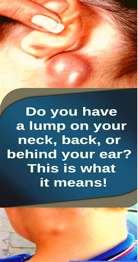 Do You Have a Lump on Your Neck,Back,or Behind Your Ear This Is What It Means # ...