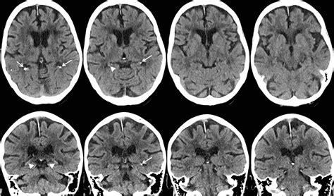 Smoking and diabetes linked to brain calcifications