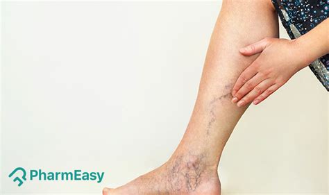 Simple Home Remedies for Varicose Veins - PharmEasy Blog