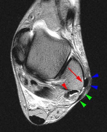 Peroneal Tendon Dislocation and Superior Peroneal Retinaculum Injury ...