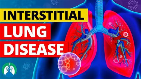 Interstitial Lung Disease - FAQs