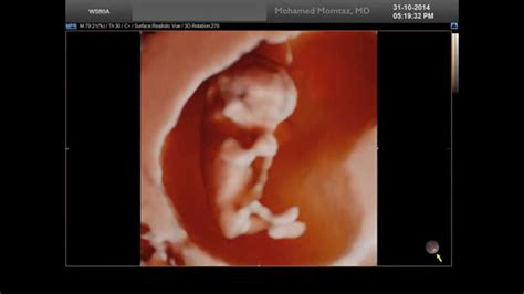 5D Ultrasound - YouTube