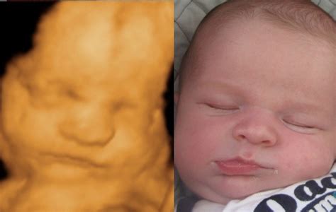 Before & After Photo Gallery – 3D and 4D Ultrasound Virginia | Baby ultrasound pictures, 3d ...