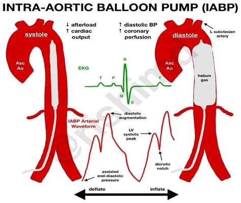 Intra Aortic Balloon Pump Placement