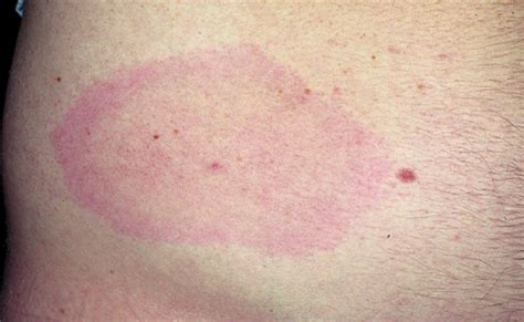 The characteristic bullseye rash for Lyme disease | Innatoss