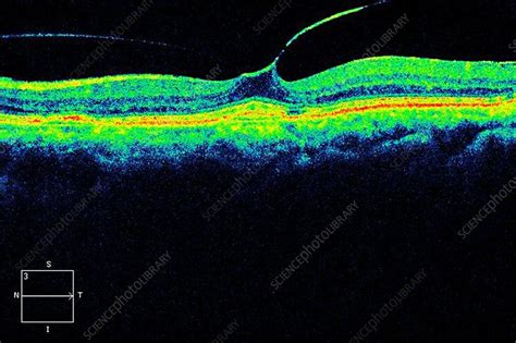 Epiretinal membrane, OCT scan - Stock Image - C024/0944 - Science Photo ...