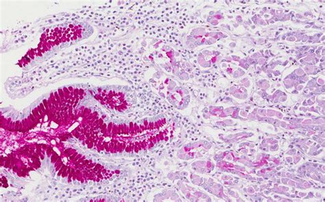 Pas Stain (Periodic acid–Schiff stain) | eMedicalHelp