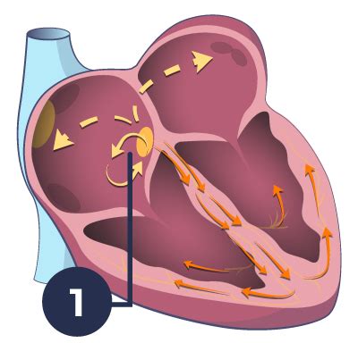 What Is Atrioventricular Nodal Reentry Tachycardia (AVNRT)? - Rhythm Doctor