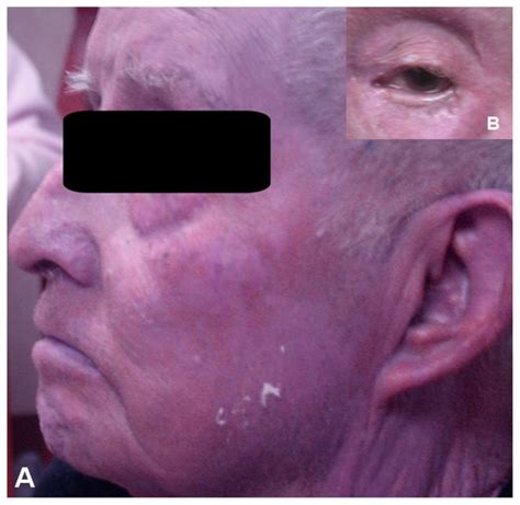 Clinical picture of the patient’s face showing the gray-bluish hue of... | Download Scientific ...