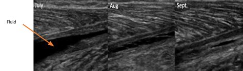 Calf Tear - Tennis Leg | Complete Physio