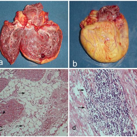 a: The cardiac MRI showed enlargement of right ventricle and atrium ...