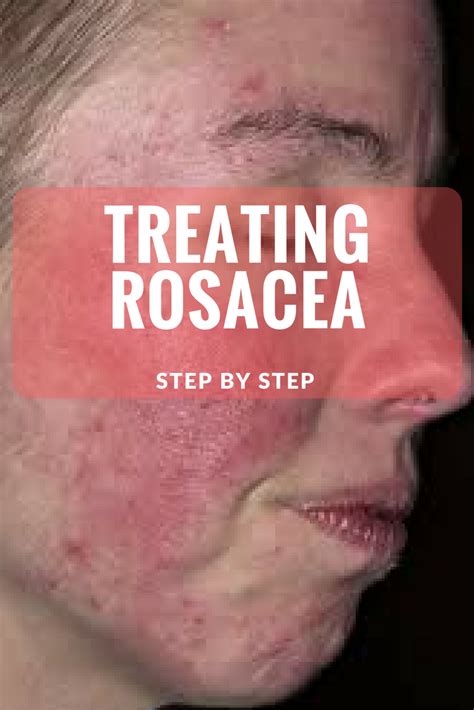 Pin auf Rosacea Cream