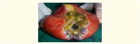 Left Ovarian Dermoid cyst showing hairs, fat and bony tissue. | Download Scientific Diagram