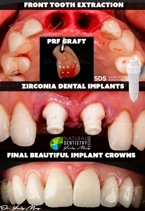 Front Tooth Zirconia Implants