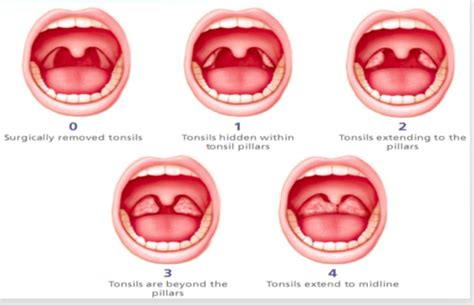 No Tonsils