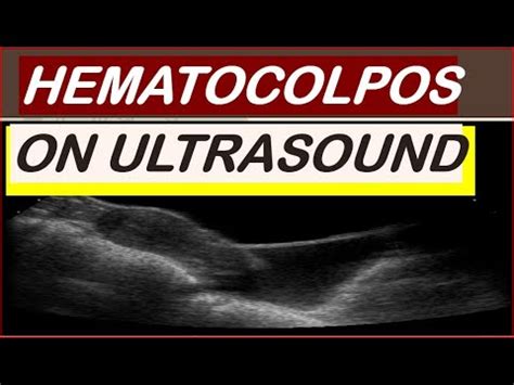 Hematocolpos on ultrasound - YouTube